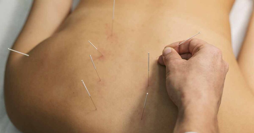 Fibromialgia e acupuntura: Como a terapia milenar pode aliviar os sintomas