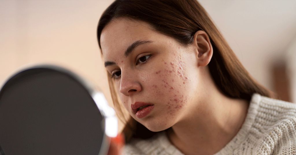 O papel do dermatologista no tratamento de acne e cicatrizes