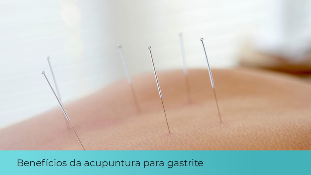 benefícios acupuntura para gastrite