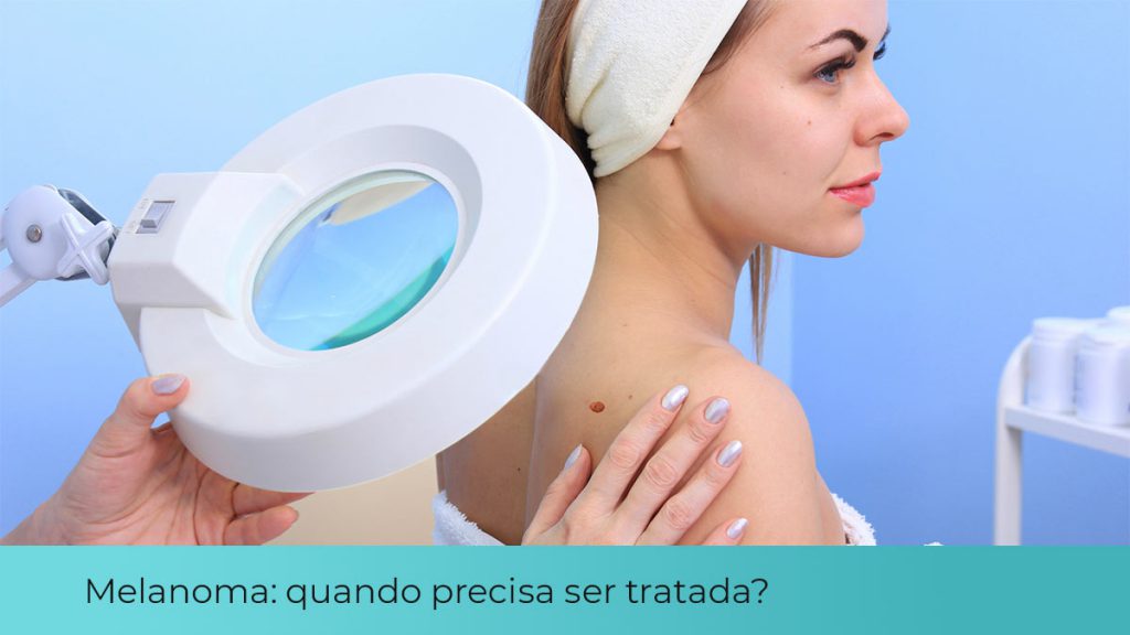 Melanoma quando tratar