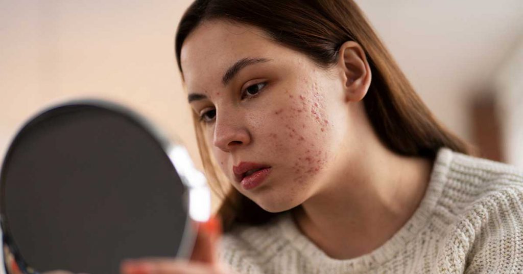 Acne Entenda quando é hora de procurar um dermatologista